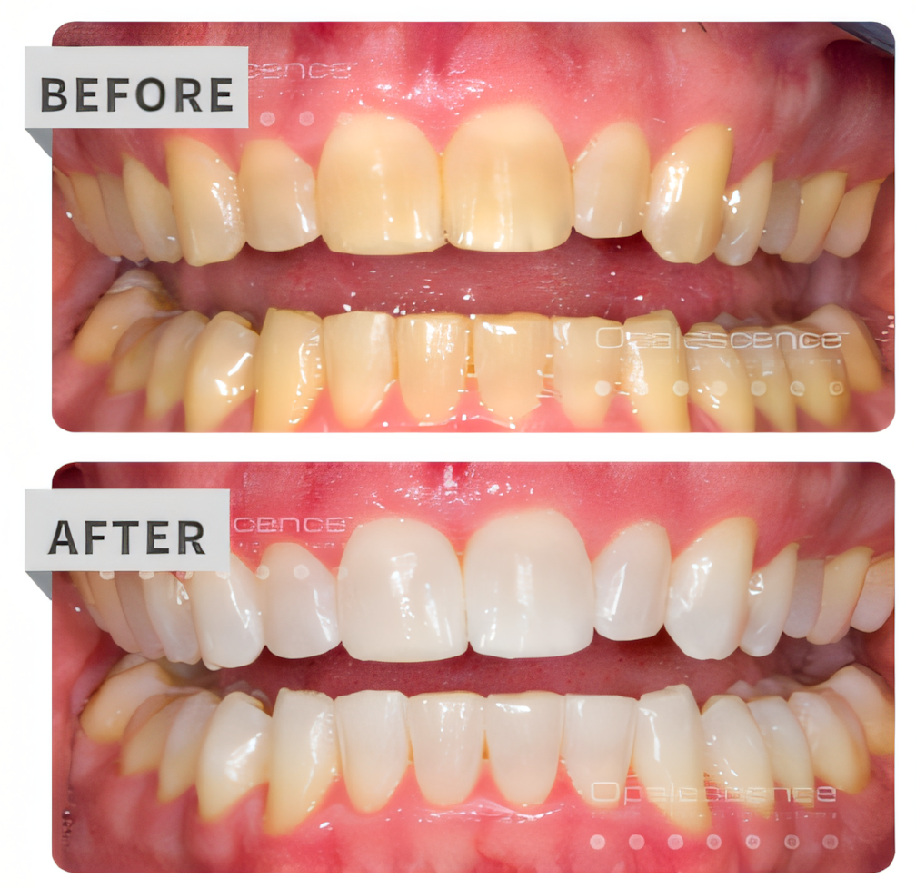 Professional Teeth Whitening in Buffalo Grove, IL